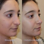 revision-rhinoplasty-nj-0967